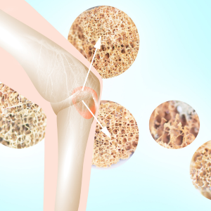 benefici-della-vitamina-d-ossa-forti