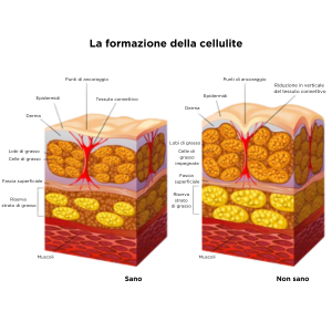 come-combattere-la-cellulite-inner